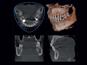 Ilustrativni prikaz 3D CBCT snimka — presek i rekonstrukcija vilice